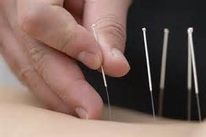 acupuncture for neck pain, acupuncture, acupuncture physio, nerve treatment,
