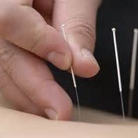 acupuncture for neck pain, acupuncture, acupuncture physio, nerve treatment,