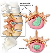 back pain, physiotherapy, edinburgh, chronic, treatment