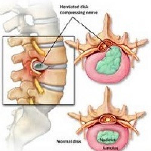 small-disc-prolapse-physiotherapy